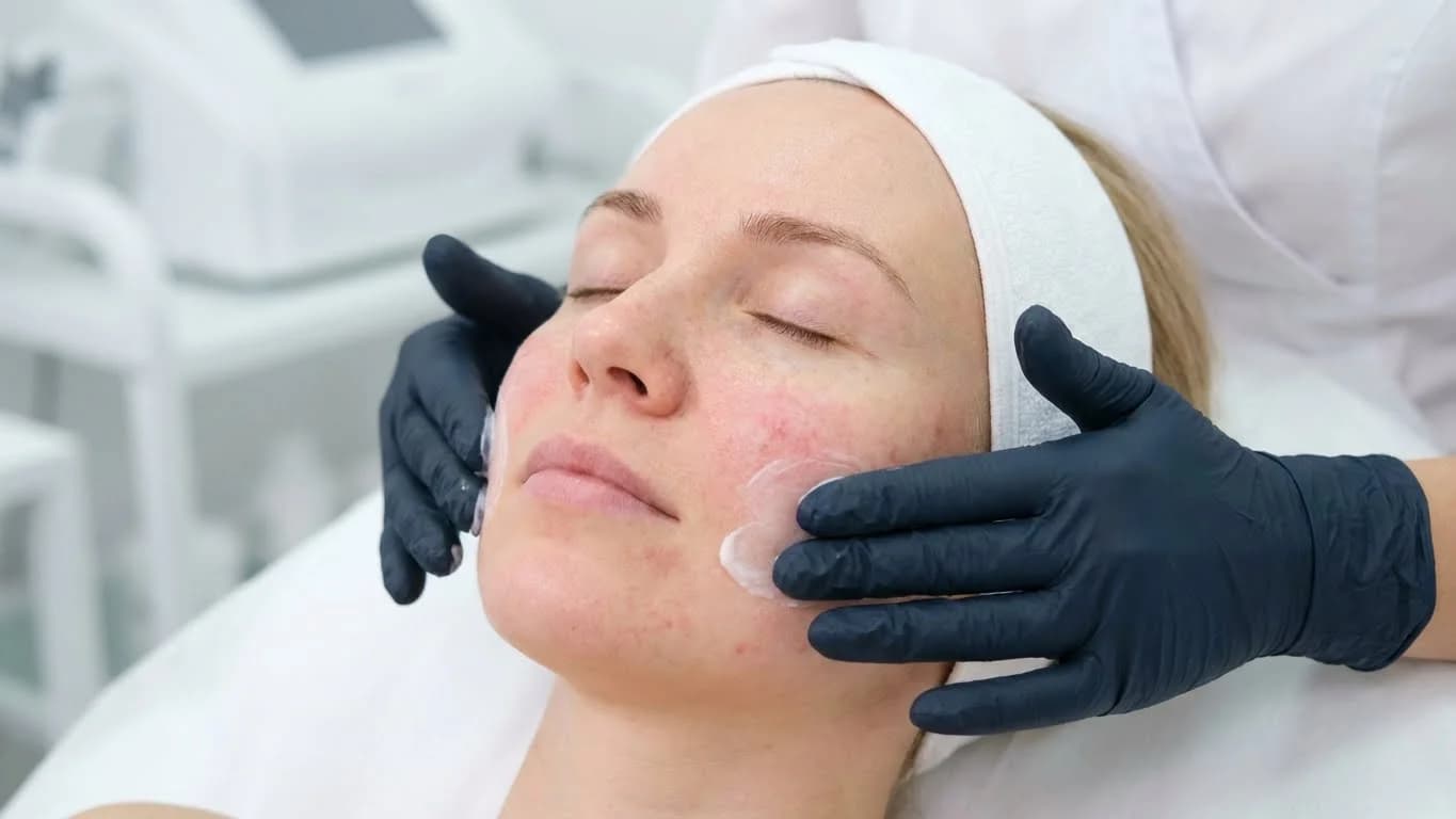 Couperose behandeling behandeling bij Beauty Icon Almere