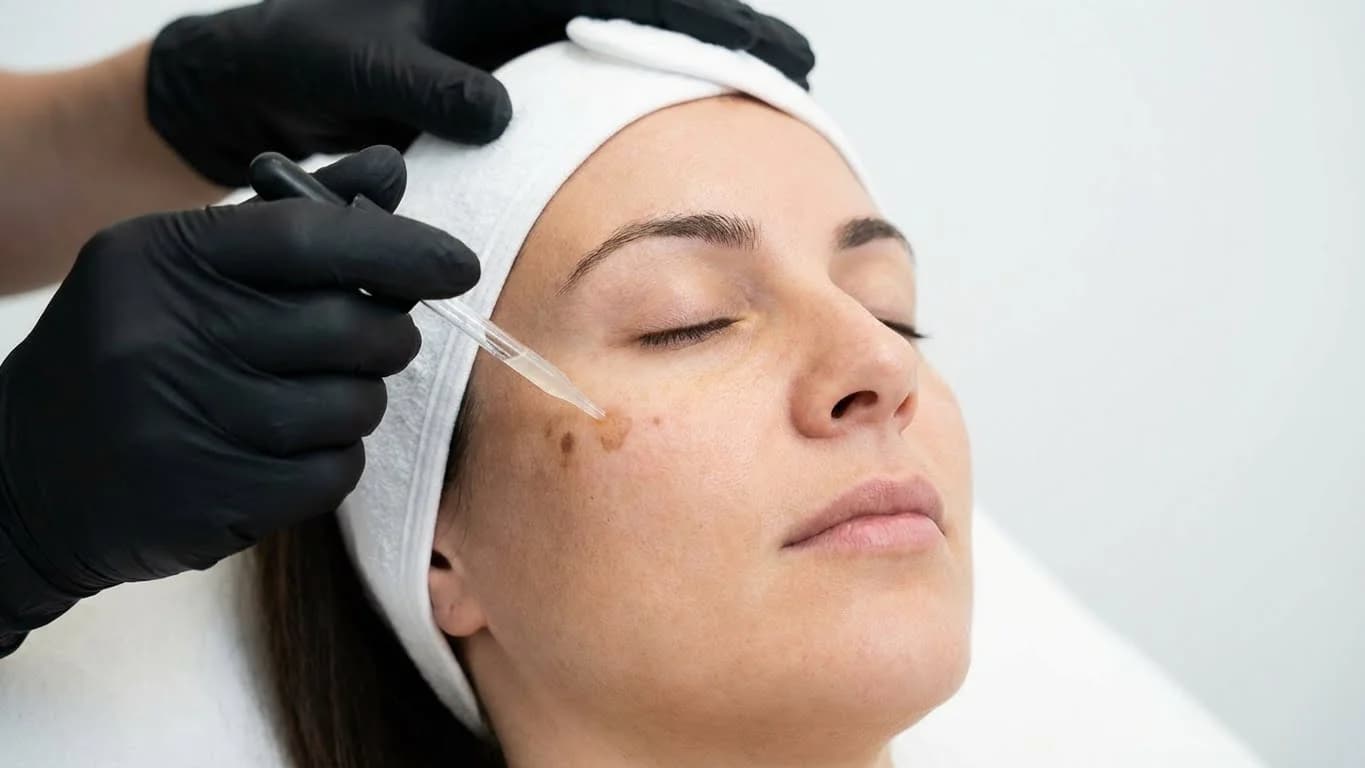Pigmentvlekken behandeling behandeling bij Beauty Icon Almere