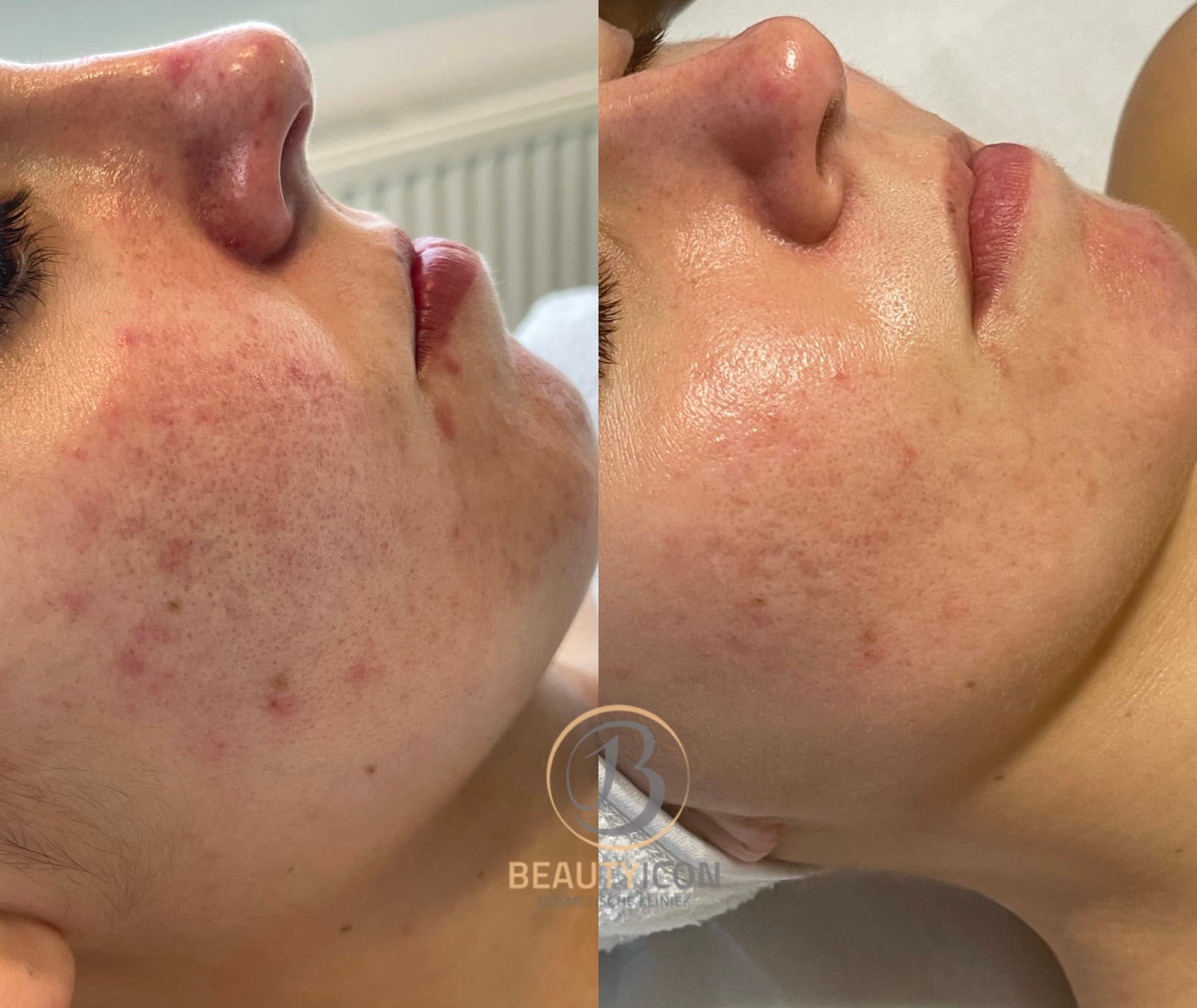 Acne behandeling