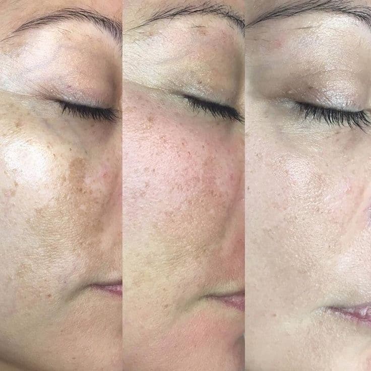 TCA chemische peeling procedure