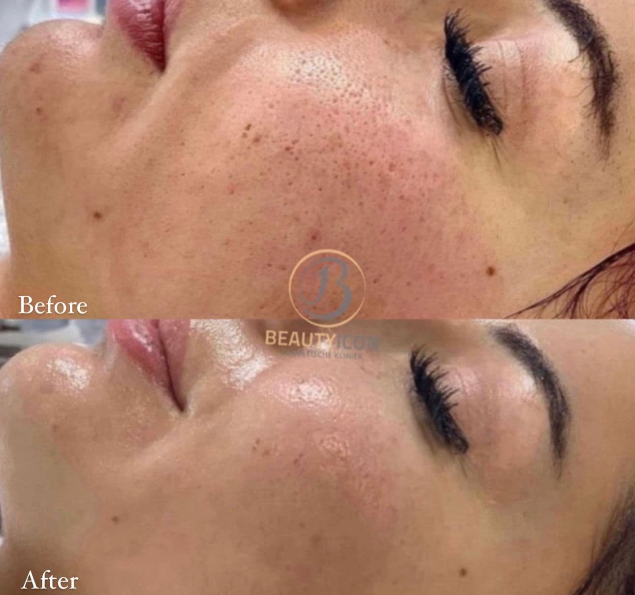 Microneedling - Verwachtingen