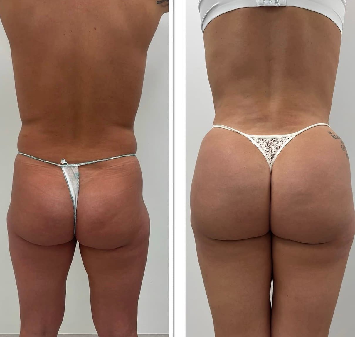 Bil vergroting met fillers behandeling bij Beauty Icon Almere