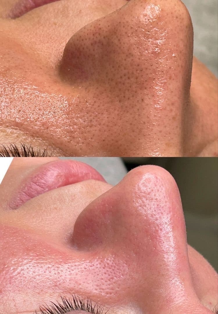 Hydra facial - Before & After