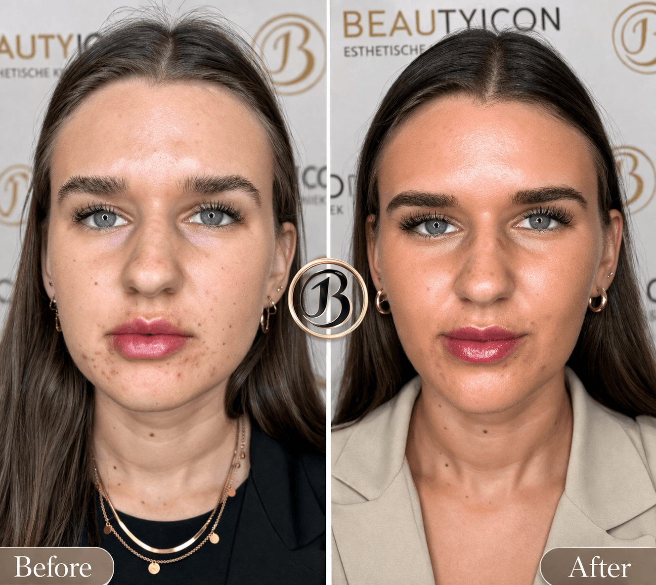 Face slimming procedure