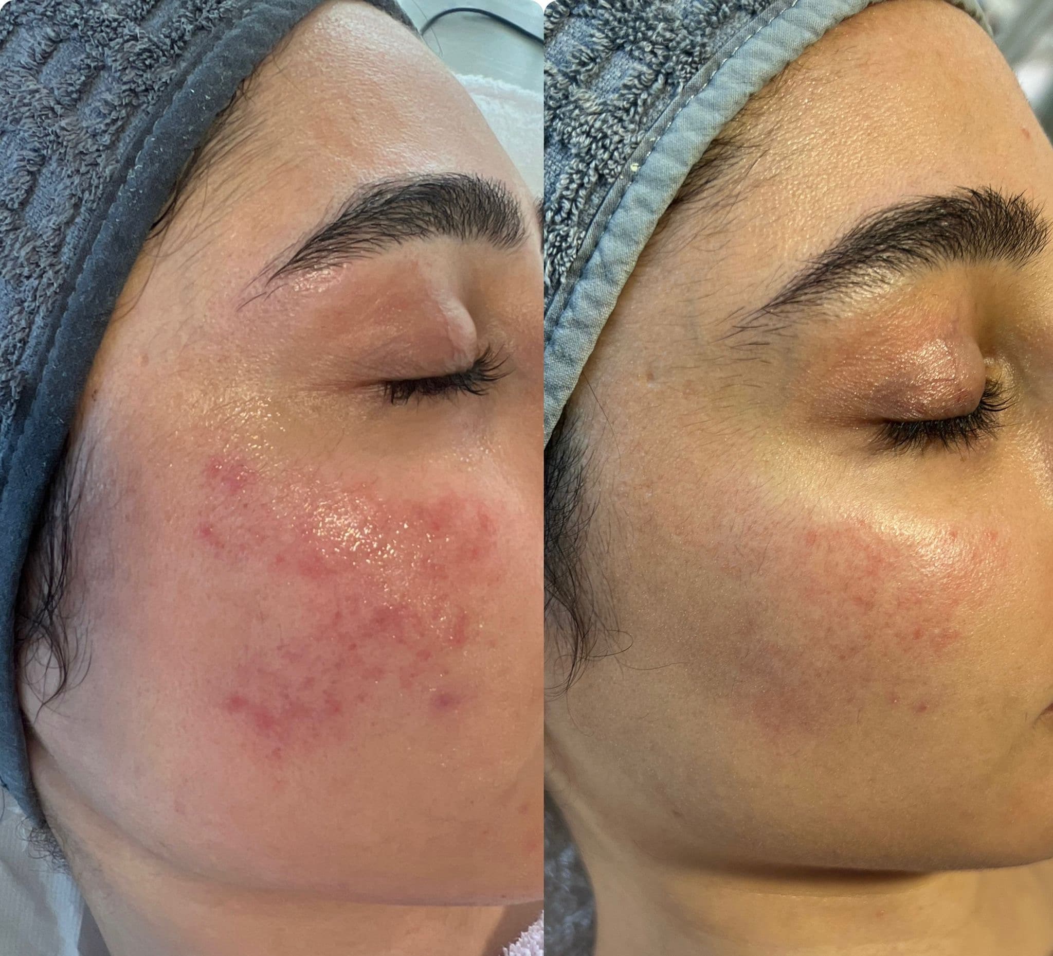 Acne behandeling procedure