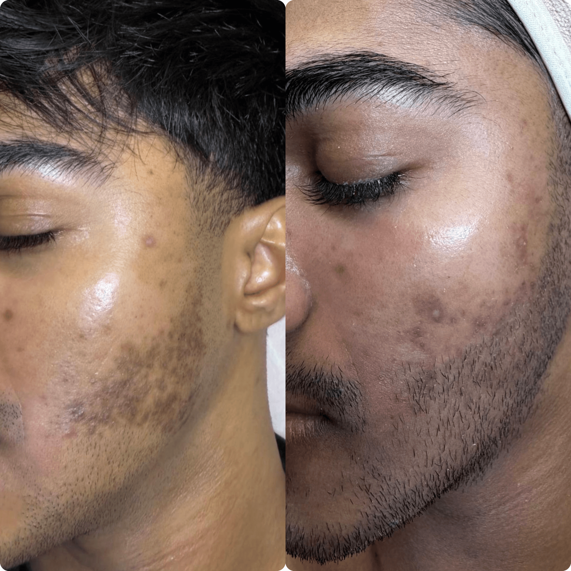 Acne behandeling voordelen