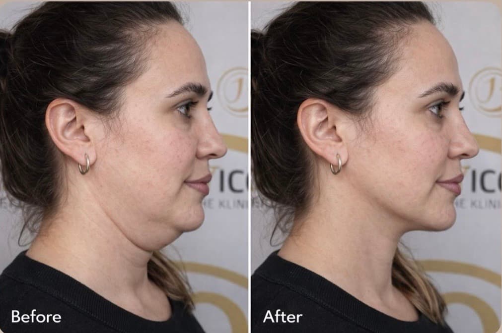 Lemon Bottle Lipolyse - Before & After