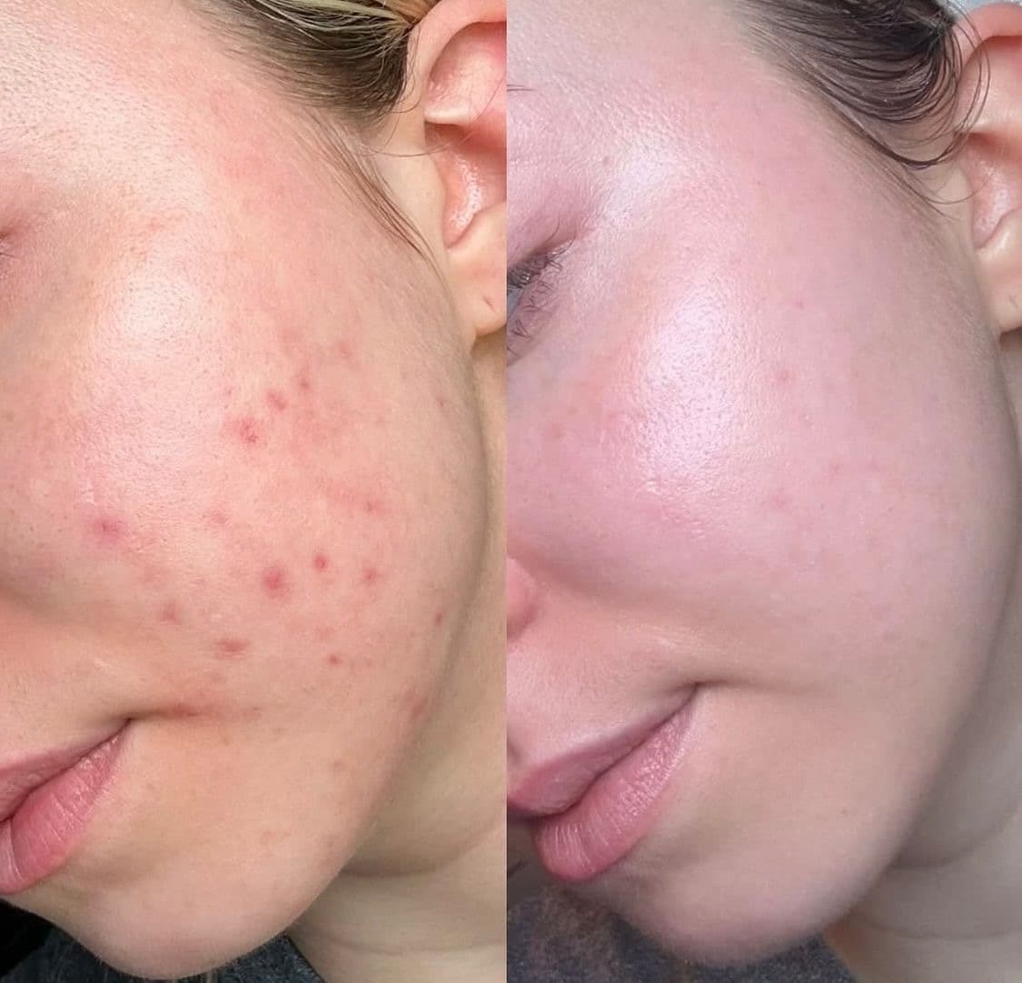 Acne behandeling - Before & After