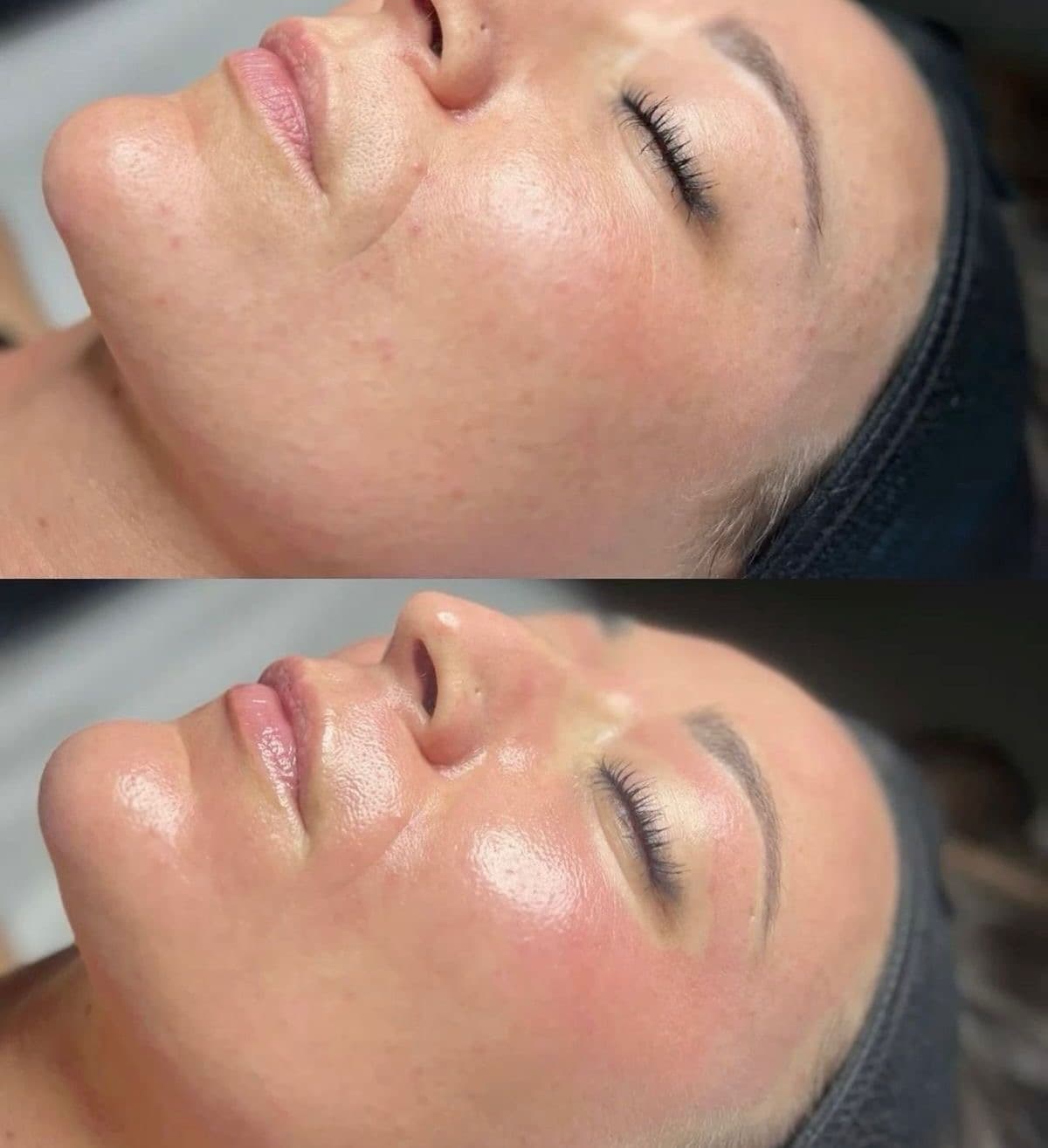 PRP Gezichtsbehandeling procedure