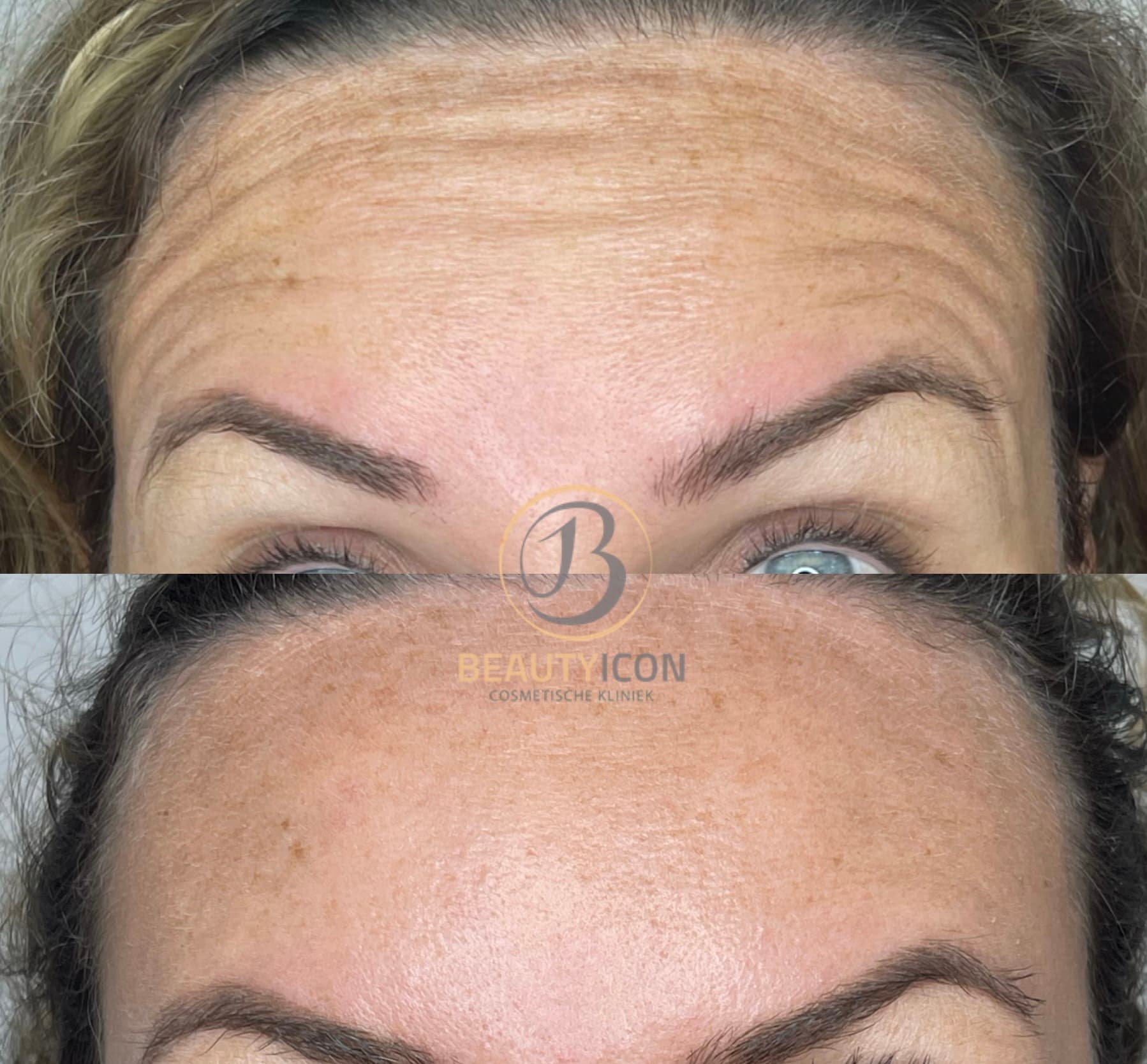 Voorhoofd rimpel procedure