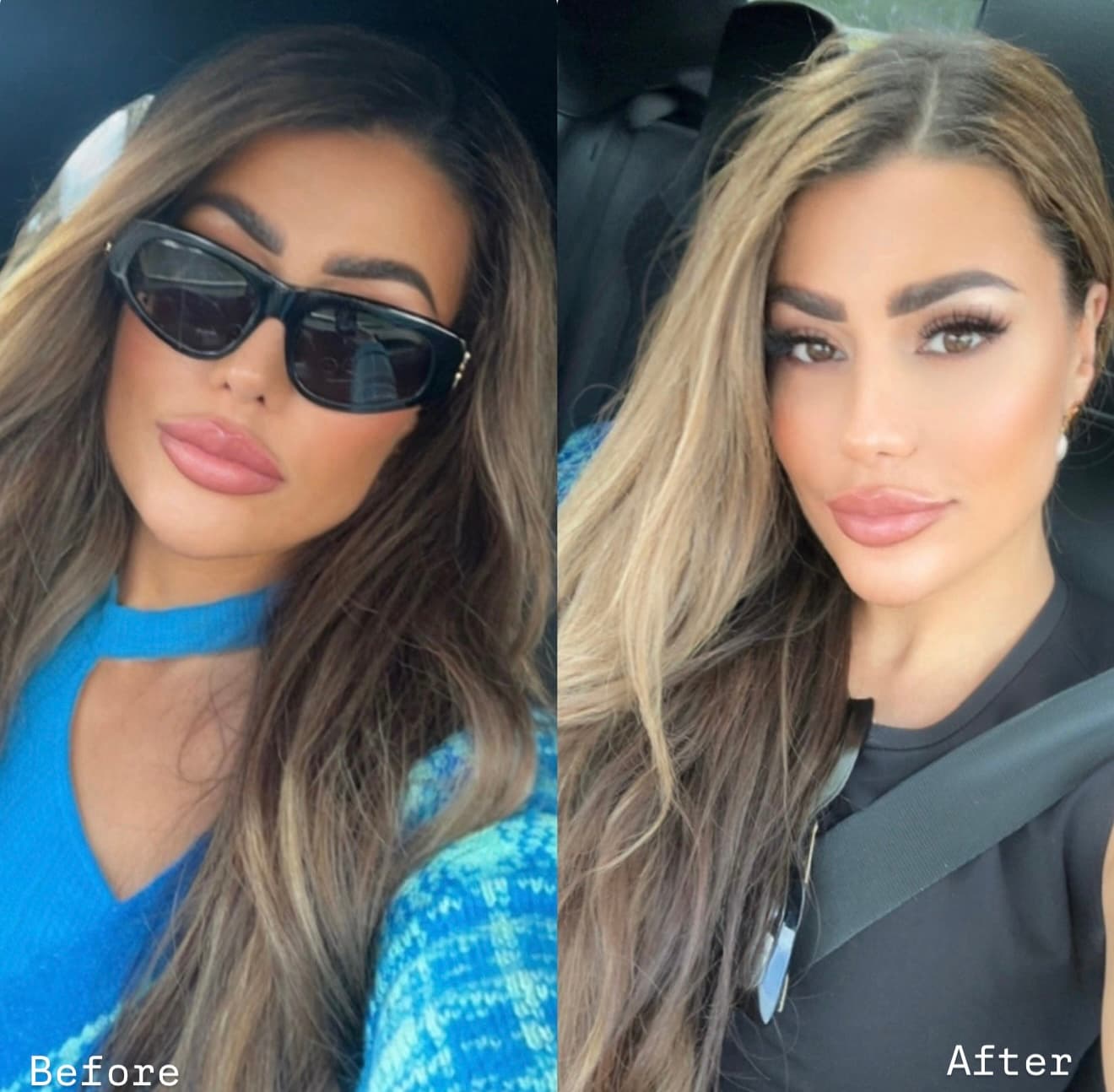 Face slimming