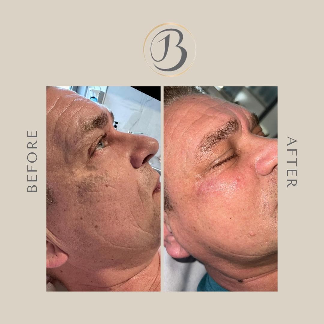 Acne behandeling geschiktheid