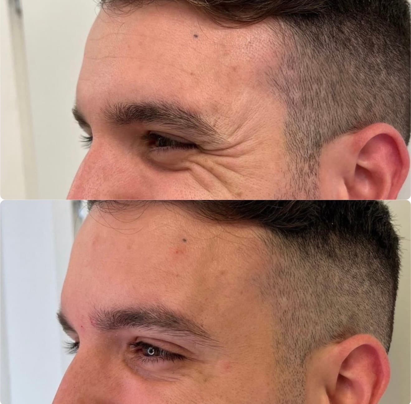 Kraaienpootjes procedure