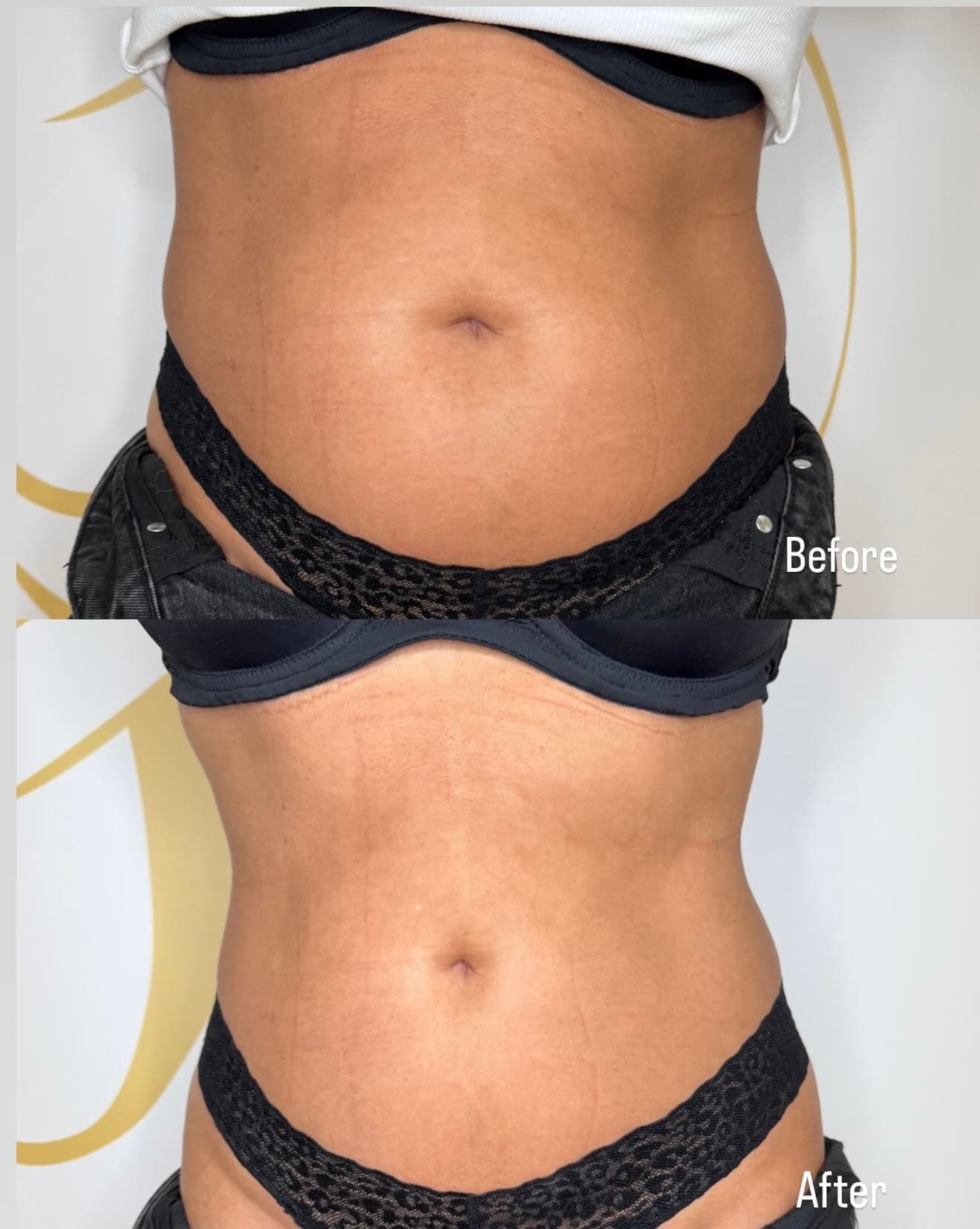 Vetbevriezing/Cryolipolyse - Before & After