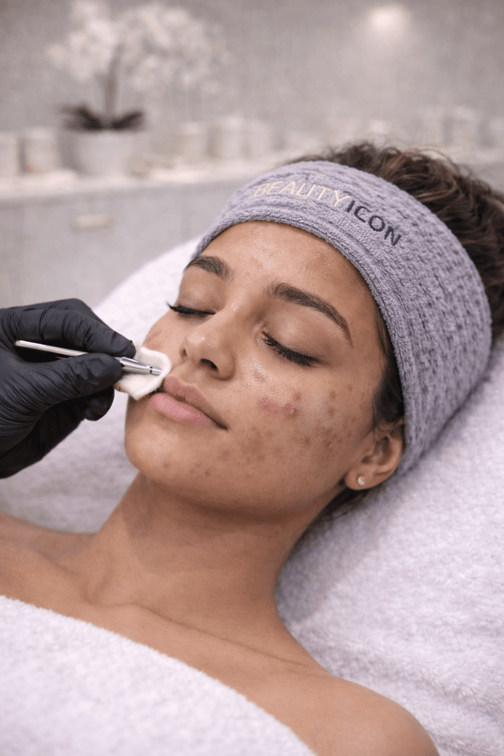 Acne behandeling behandeling bij Beauty Icon Almere
