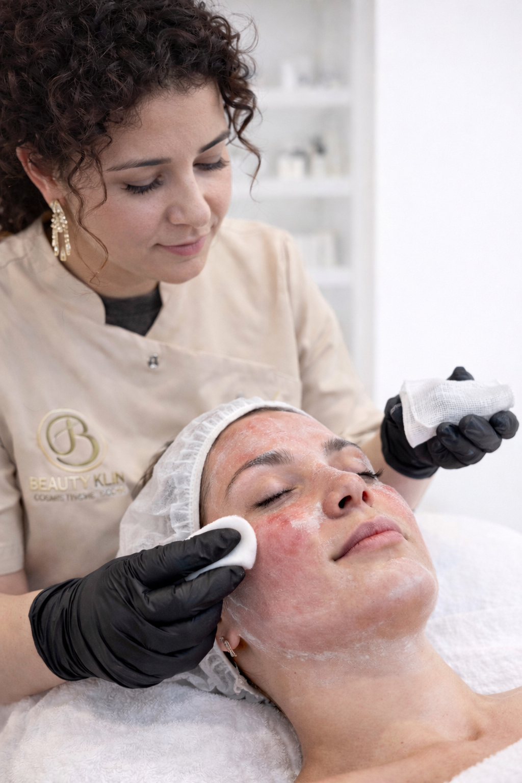 TCA chemische peeling