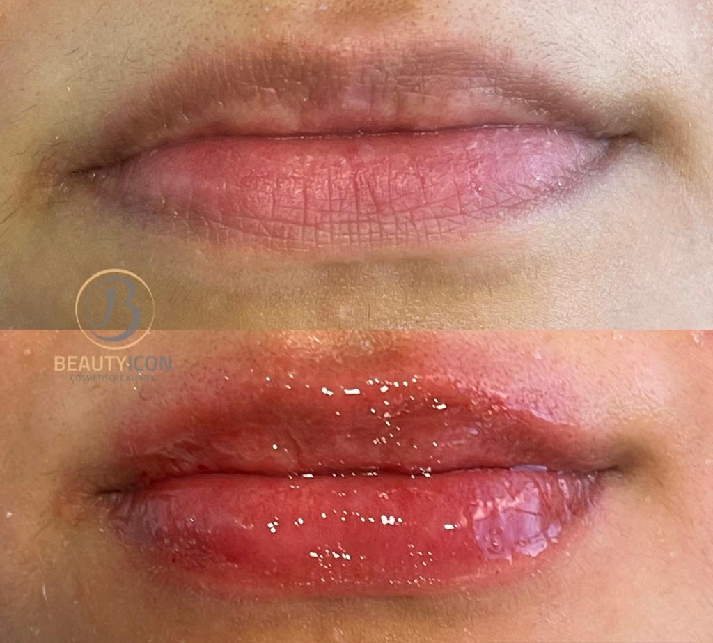 Lip Collageen Before After